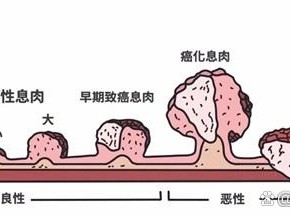 胆囊息肉从良性到恶性发展过程图