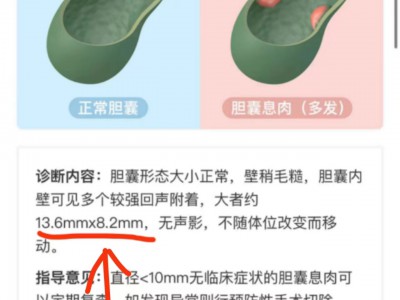 胆囊病友案例：胆囊息肉13.8MM变小到8.8MM（含三味药方和经验总结）
