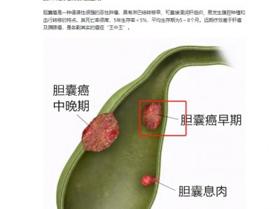 胆囊息肉到胆囊癌的变化
