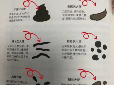 胆囊病人通过消化大便分析病情