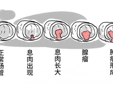 胆囊切除后，肠镜复查肠息肉注意的几种情况