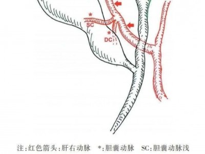为什么胆囊手术前要做核磁共震检查？